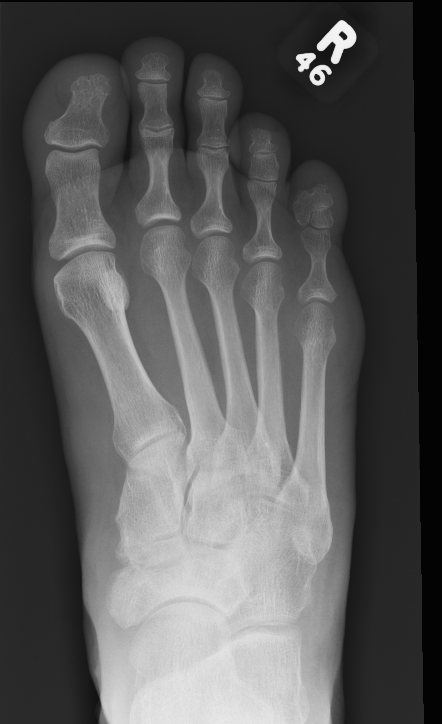 Navicular AVN